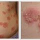 Illustration for article titled obat herpes zoster